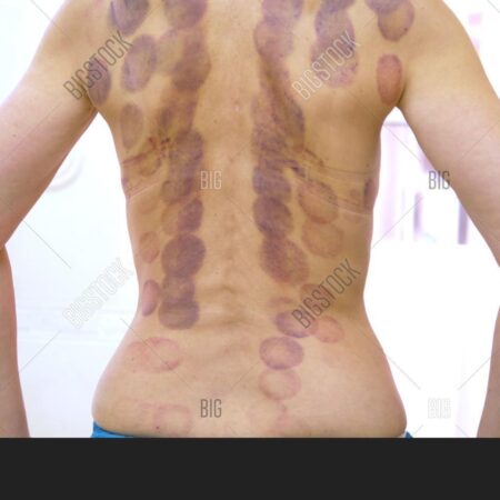 Евгения Бушар демонстрирует жуткие фотографии после баночного массажа